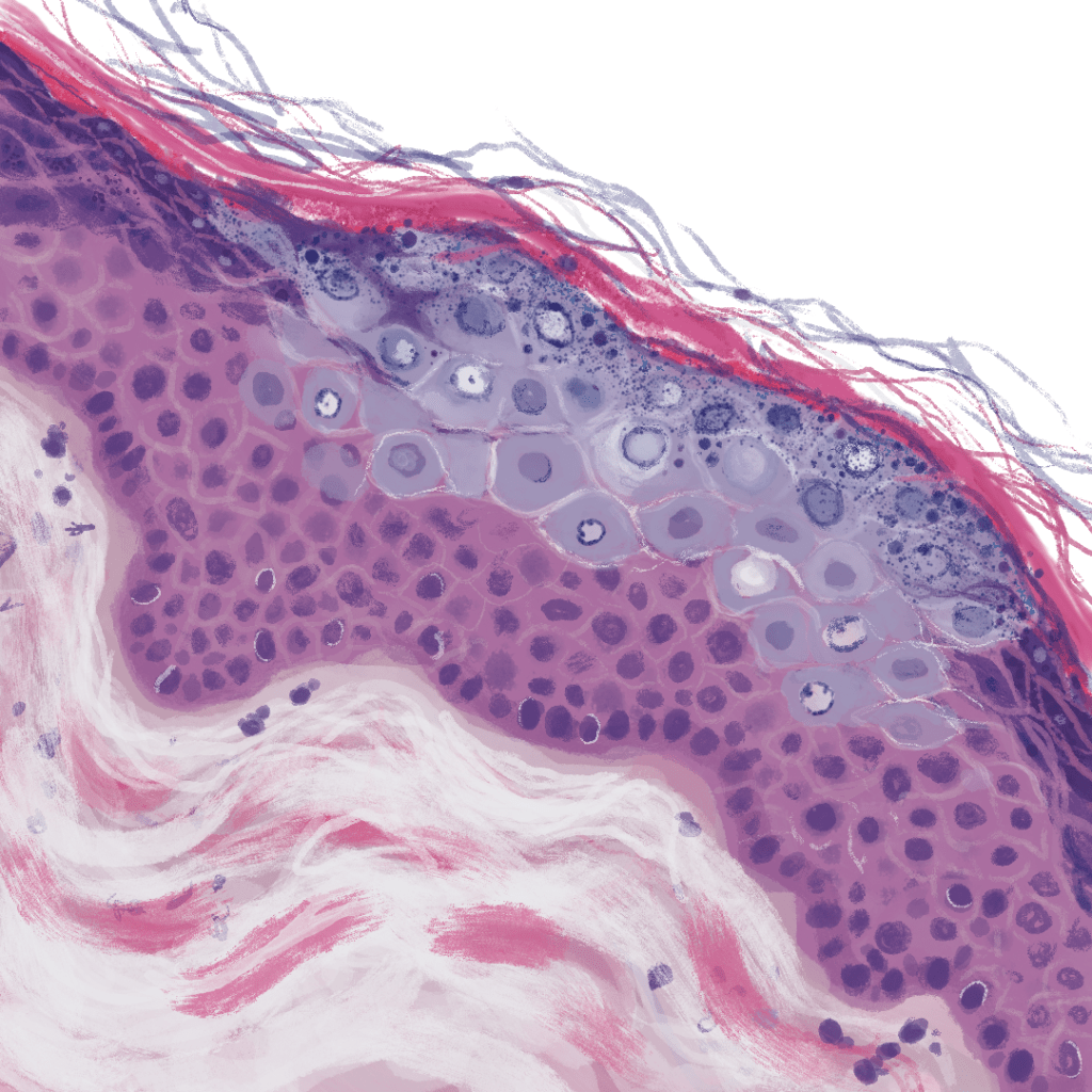 Dermpath Doodles: EDV